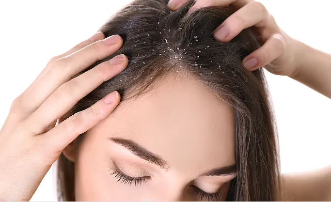 What Is Dandruff?