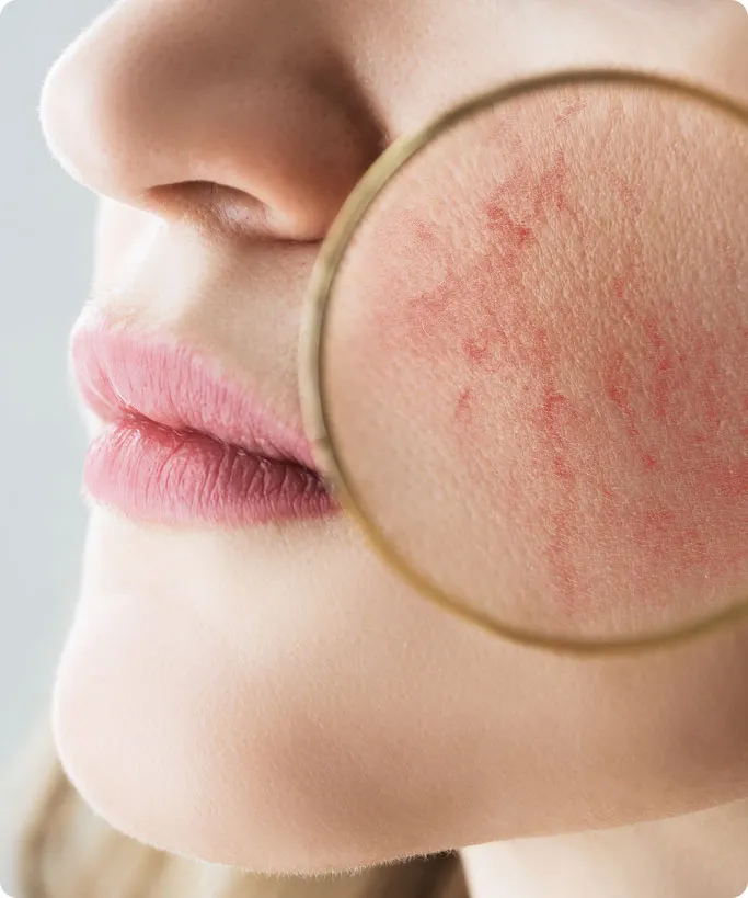 What Is Rosacea?