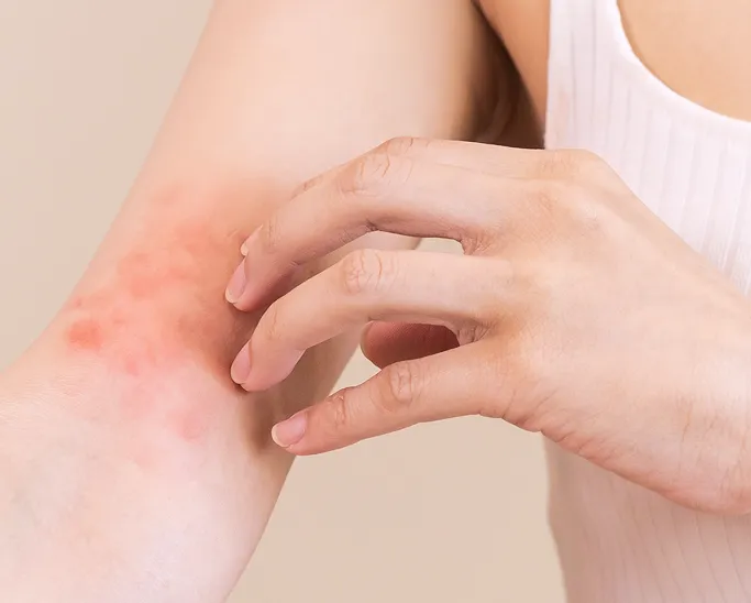 What is a Skin Allergy?