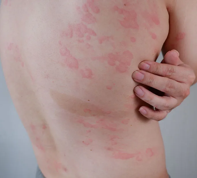 What Is a Skin Infection?